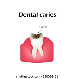 Deep tooth decay. Vector illustration on isolated background.