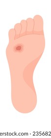 Ilustración del vector de enfermedades de los pies de la úlcera profunda