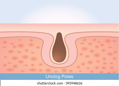 Deep Unclog Pores. This Illustration About Skin Care And Beauty.