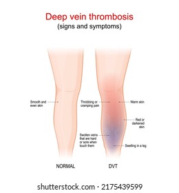 Deep Vein Thrombosis Is A Blood Clot In A Vein, Usually The Leg. Healthy Leg, And Leg With DVT. Sign And Symptoms Of Thrombophlebitis. Blood Vessels Disease. Vector Illustration