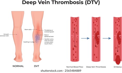 Deep Vein Thrombosis Design Vector Illustration