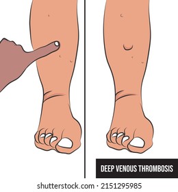 Deep Vein Thrombosis (DVT) Is A Condition That Occurs When A Blood Clot Forms In A Deep Vein.