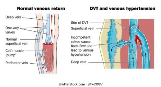 Deep Vein Thrombosis - Labeled