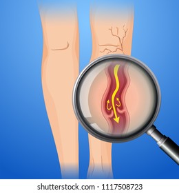 Deep Vein Thrombosis On Leg Illustration