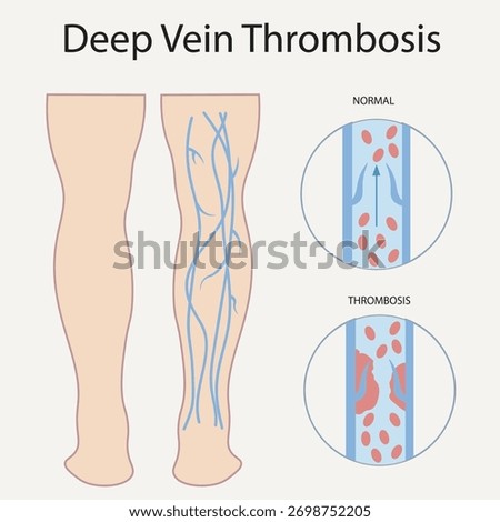 Deep vein thrombosis vector: shows leg swelling, pain, warmth, redness, vein tenderness; highlights risk of pulmonary embolism and similarities to varicose veins and cellulitis.icon