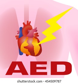 Defibrillator, Automated External Defibrillator (AED), image illustration
