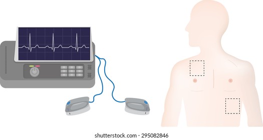 Defibrillator Positions