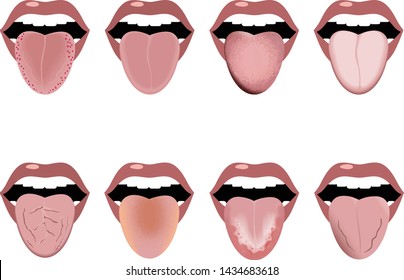 Definition of the disease by tongue. Open mouth and tongue sticking out. Changes in color and appearance in diseases. Vector image.