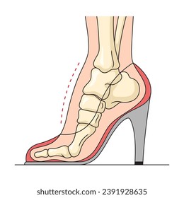 Deformation of the foot bones in high heeled shoes structure vertebral column diagram hand drawn schematic vector illustration. Medical science educational illustration