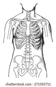 Deformed by the corsets, showing condition of bones in women who habitually wear tight corsets, vintage engraved illustration. 