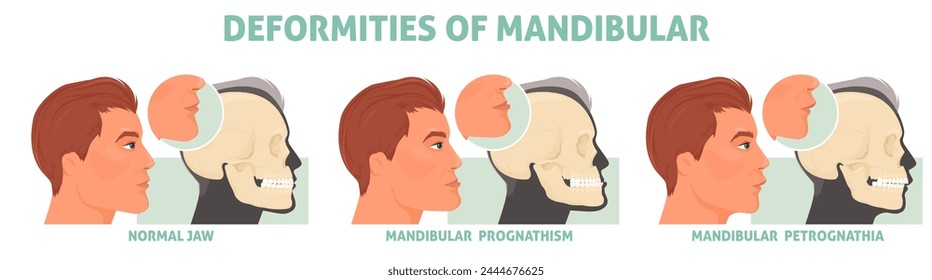 Deformities of mandibular with normal jaw, prognathism and petrognathia symptom medical poster vector illustration. Cranio defects, facial cosmetic disorder