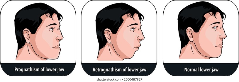 Deformities of mandibular with normal jaw, prognathism and petrognathia

