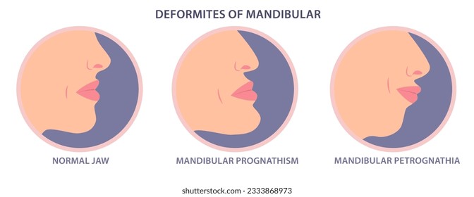 Deformities of mandibular vector illustration. Mandibular deficiency and excess. Jaw surgery and modification. Facial deficiency, midfacial problems. Jaw Deformity. maxillary prognathism correction.