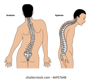 Deformities of the spine