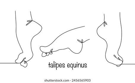 A deformity of the foot in which the front part of the foot is lowered down and the heel is raised and directed upward. Leg with deformation in various turns. Vector illustration.