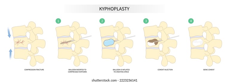 degeneration disk disease with kyphoplasty spine of dowager’s hump posture hunched back bone joint neck pain surgical over backbone vertebral column