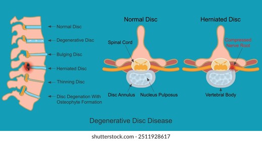 Doença Degenerativa do Disco é um fragmento do núcleo do disco que é empurrado para fora do anulo, para o canal espinhal através de uma ruptura ou ruptura no anulo.