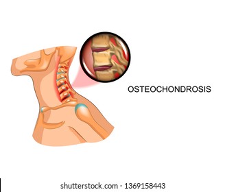 degenerative disc disease and neck pain