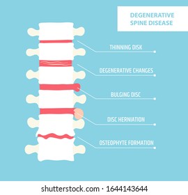 Degenerative Erkrankung der Festplatte. Spinale Arthritis. Vertebrale Hernie