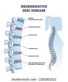 Degenerative disc disease with spine and vertebra trauma outline diagram. Labeled educational normal intervertebral, degenerated, bulging, thinning and herniated problem example vector illustration.