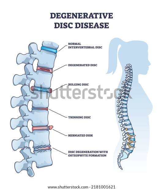 Degenerative Disc Disease Spine Vertebra Trauma Stock Vector (Royalty ...