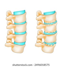 Degenerative Scheibe mit Osteophytenbildung und normaler Wirbelsäule. Reifung der Wirbelsäule mit Knochenspornen und Bandscheibenvorfall. Spinale Osteoarthritis Vektorgrafik