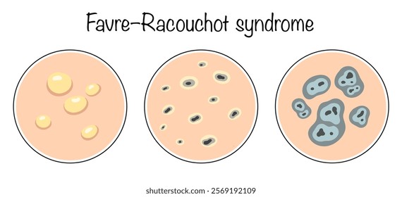 A degenerative disease of connective tissue, manifested by the appearance of yellow papules, plaques, comedones and cysts. Hand-drawn variants of the manifestation of the disease on the skin.