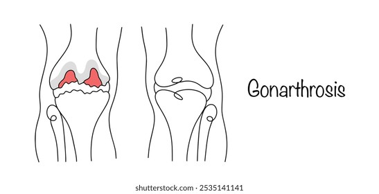 Degenerative disease within the articular cartilage of the knee joint. Knee with gonarthrosis with a healthy knee. Medical illustration on the topic of joint diseases. Isolated vector 