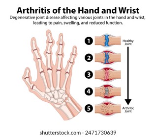 degenerative Gelenkerkrankung mit Auswirkung auf Hand und Handgelenk