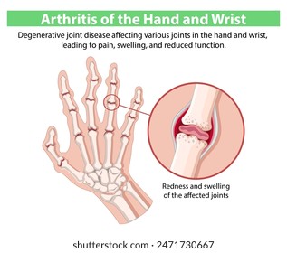 Degenerative joint disease affecting hand and wrist