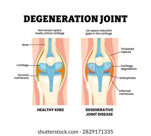 Degenerative joint knee disease. Labeled thickened capsule, cartilage degradation, osteophytes, inflamed membrane. Synovial joint anatomy. Frontal view of human knee joint. Vector illustration.