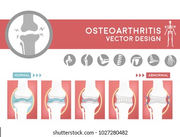 Degenerative Of Osteoarthritis Flat Cartoon Vector Design, Sequencing Of Damage Joint From Arthritis