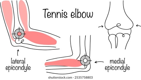 Lesão degenerativa-inflamatória dos tecidos da articulação do cotovelo nos locais de fixação dos tendões e músculos aos epicôndilos. Vetor médico colorido. Cotovelo de tênis. 