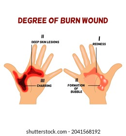 83 Wound classification Images, Stock Photos & Vectors | Shutterstock