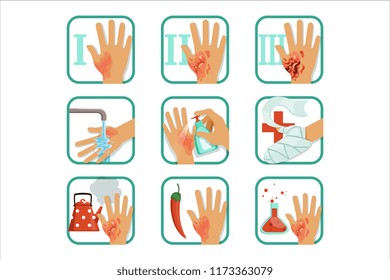 Degree burns set, burns treatment and classification vector Illustrations