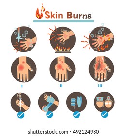 Degree Burns and Thermal Burns Treatment,Vector illustrations