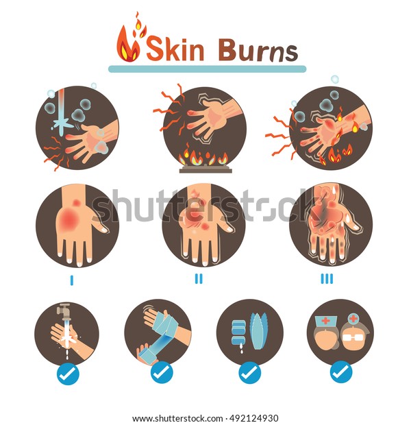 Degree Burns Thermal Burns Treatmentvector Illustrations Stock Vector ...