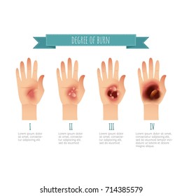 Degree of skin burns. Flat vector illustration for websites, brochures, magazines, web