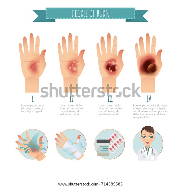 Degree Skin Burns Burns Treatment Vector เวกเตอร์สต็อก (ปลอดค่า ...