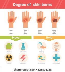 Degree of skin burns. Vector. Cartoon. Isolated. Flat. Illustration for websites, brochures, magazines. 