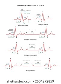 Degrees of atrioventricular block. Diagram of normal rhythm and AV block for a human heart. Heart cardiogram. Vector illustration in flat style isolated on white background