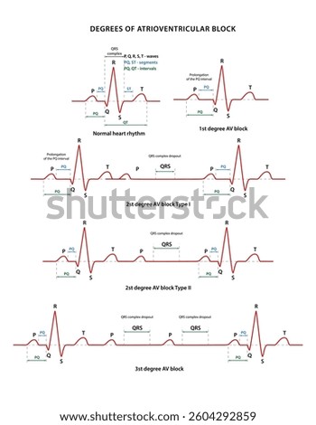 Degrees of atrioventricular block. Diagram of normal rhythm and AV block for a human heart. Heart cardiogram. Vector illustration in flat style isolated on white background