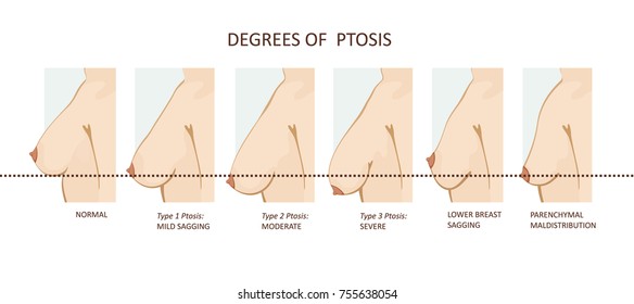 Degrees of breast ptosis 