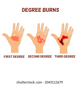 Degrees Burn 3 Palms Hand Show Stock Vector (Royalty Free) 2043112679 ...