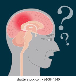 Dementia of aged person, structure of human brain 