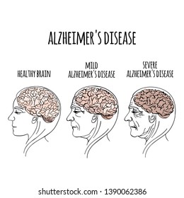 DEMENTIA Alzheimer Disease Medicine Vector Illustration