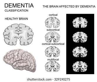 dementia, Alzheimer's disease and its classification