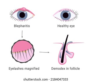 Demodex Infection Causing Blepharitis. Eyelash Mites Microscope View. Demodex Mite In Hair Follicles Of Eyelashes. Eyelid Swelling. 