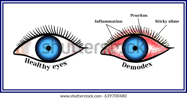 Demodex Parasitic Eye Disease Stock Vector (Royalty Free) 639700480