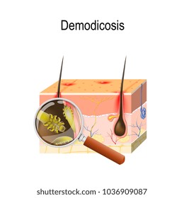 Demodicosis, called demodectic mange or red mange. Cross section of the skin with mites. Close-up demodex through magnifying glass